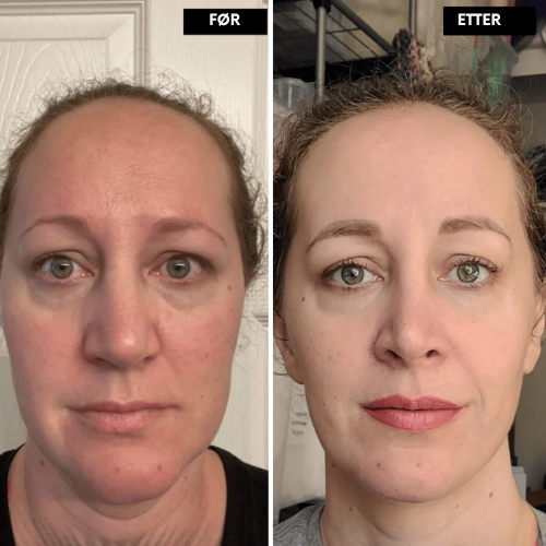 Lunora™ Det næste generations alternativ til retinol