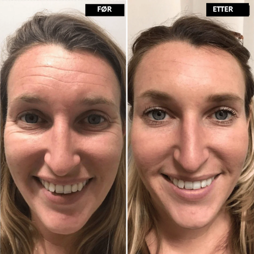 Lunora™ Det næste generations alternativ til retinol