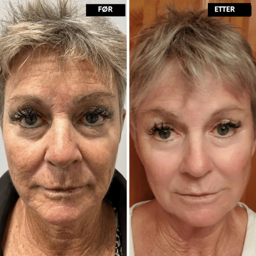 Lunora™ Det næste generations alternativ til retinol