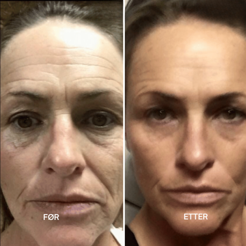 Lunora™ Det næste generations alternativ til retinol